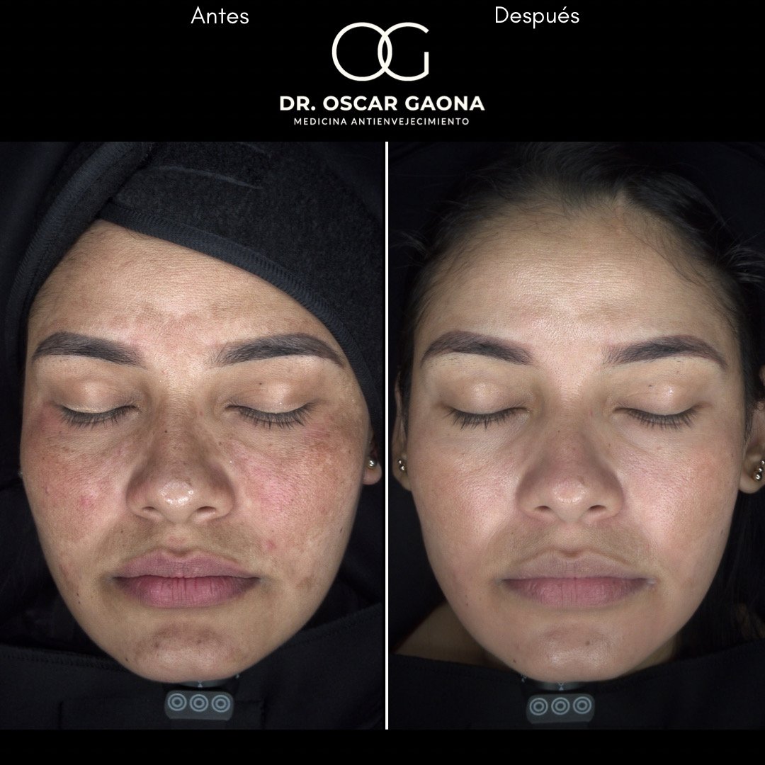 Tratamiento láser para remoción de manchas solares en Cali con el Dr. Oscar Gaona