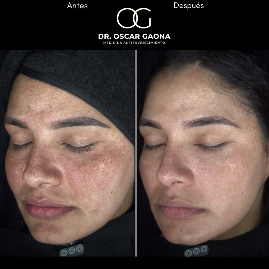 Tratamiento láser para remoción de manchas solares en Cali con el Dr. Oscar Gaona
