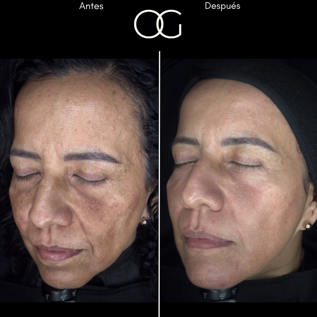 Tratamiento láser para remoción de manchas solares en Cali con el Dr. Oscar Gaona