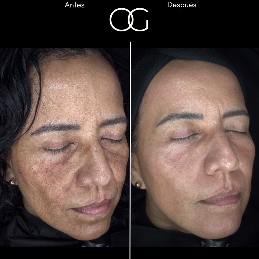 Tratamiento láser para remoción de manchas solares en Cali con el Dr. Oscar Gaona