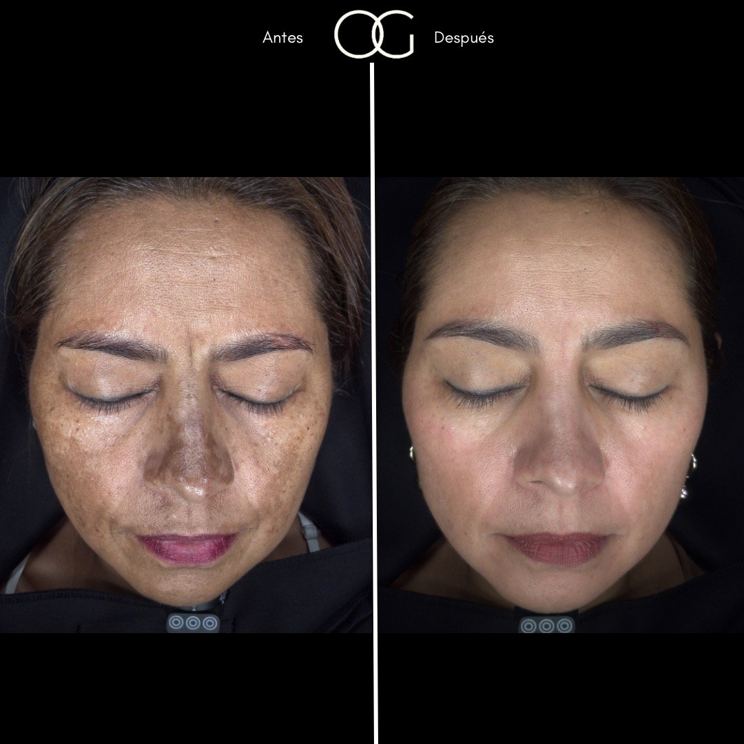 Tratamiento láser para remoción de manchas solares en Cali con el Dr. Oscar Gaona