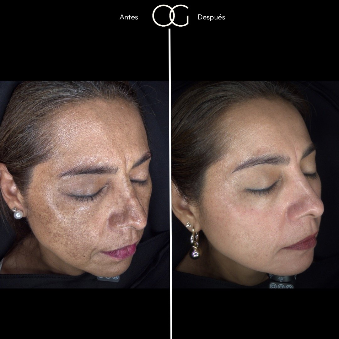 Tratamiento láser para remoción de manchas solares en Cali con el Dr. Oscar Gaona